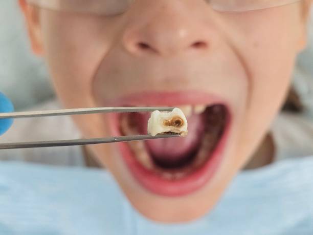 Best Emergency Tooth Extraction in Oak Creek, WI